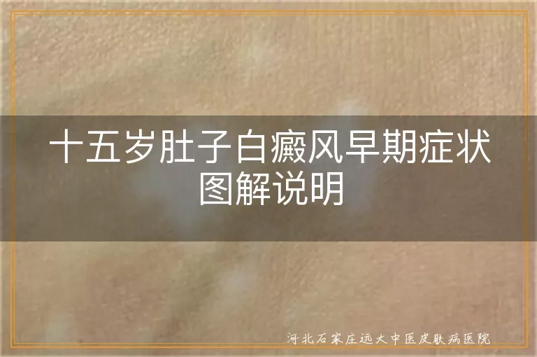 十五岁肚子白癜风初期表现,青少年白斑症状图解,肚子白斑早期识别