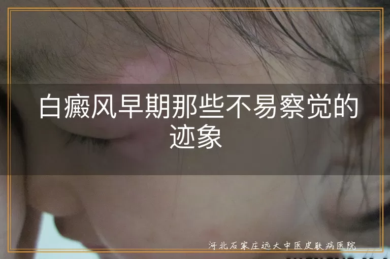 白癜风早期皮肤变化,白斑伴随感觉异常,情绪波动与白癜风