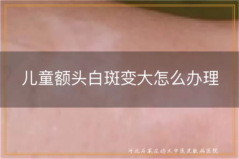 儿童额头白癜风症状,白斑变大如何处理,儿童白癜风日常护理
