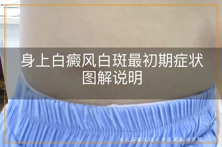 白癜风初期症状描述,白斑扩散速度观察,皮肤白斑自我检查方法