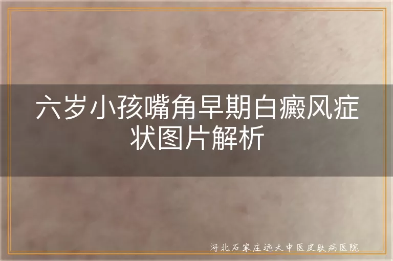 六岁小孩嘴角白癜风症状, 早期白癜风白斑特征, 儿童白癜风辨别与护理