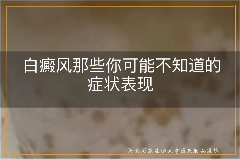 白癜风白斑表现,白癜风皮肤异常,白癜风毛发变白