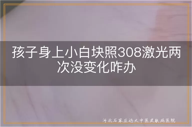 孩子白斑308激光无效咋办,白癜风治疗两次无变化,儿童白斑激光治疗未见效