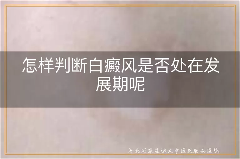 白癜风发展期症状,白斑面积变化判断,治疗效果反映病情