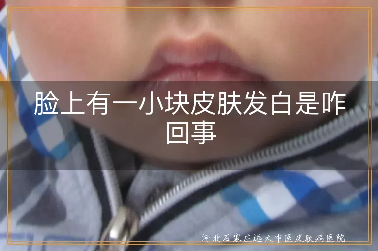 脸上白斑可能是白癜风,白癜风并非不治之症,白斑需专业医生诊断