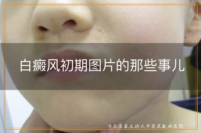 白癜风初期图片的那些事儿