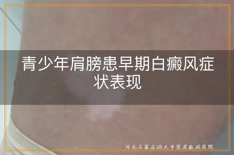 青少年肩膀白癜风症状表现,青少年白斑初期症状,白癜风早期皮肤变化