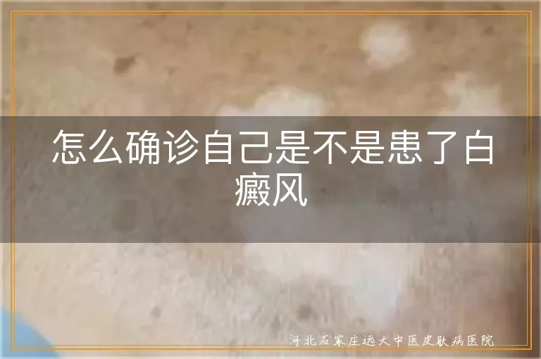 白癜风皮肤白斑特征,白斑变化与身体感觉,专业检查确诊白癜风