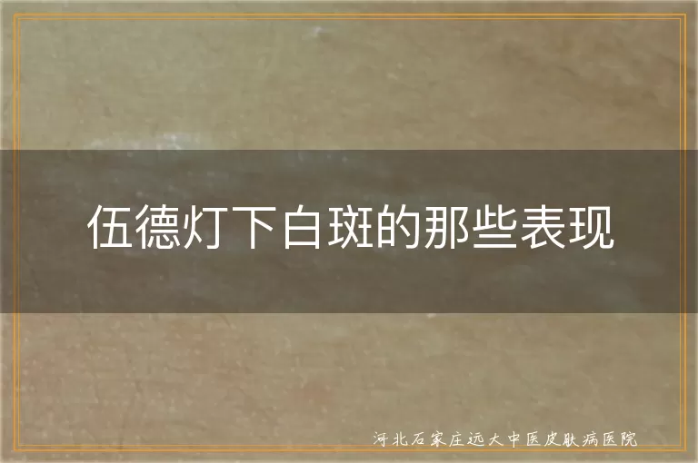 白癜风伍德灯表现,白斑伍德灯诊断,伍德灯下白斑差异