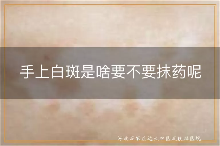 手上白癜风咋治疗,白斑需要抹药吗,白癜风日常护理