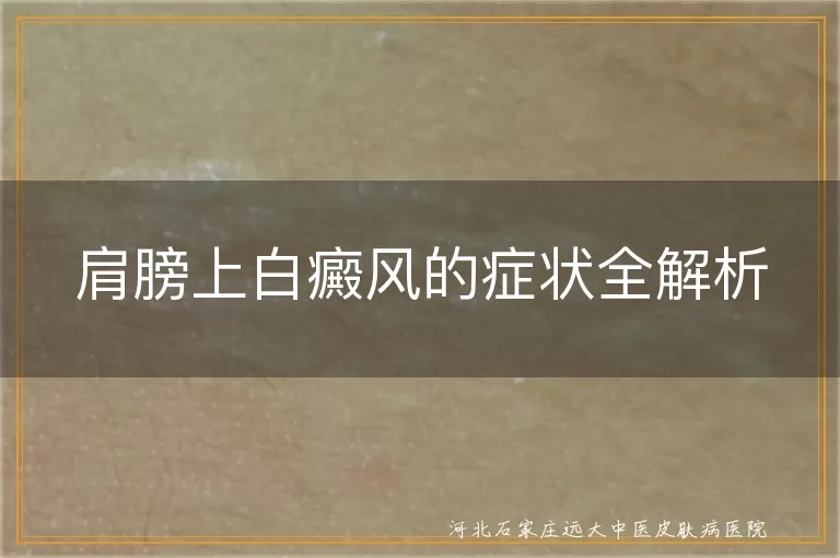 肩膀上白癜风初期表现,肩膀上白斑扩散症状,肩膀上白癜风晒太阳反应