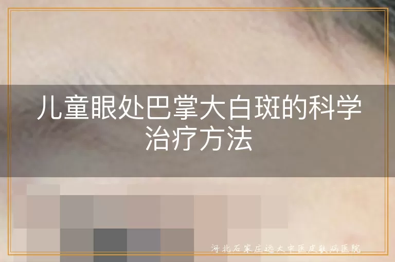 儿童眼处巴掌大白斑的科学治疗方法