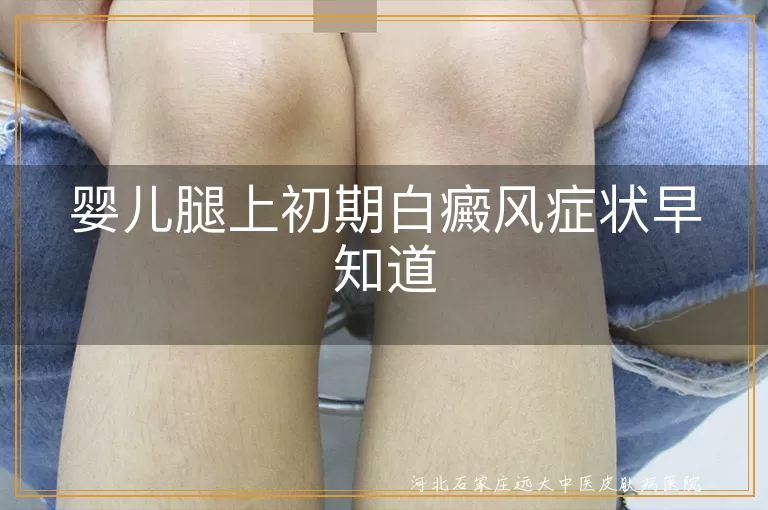 婴儿腿上初期白癜风症状早知道