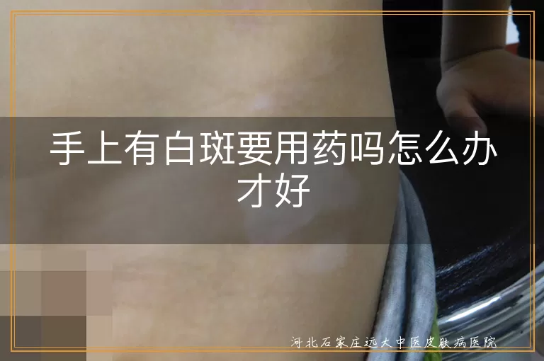 手上白斑必须用药吗,白癜风如何科学治疗,白斑恢复方法有哪些