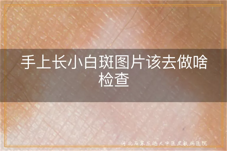 手上白斑需做哪些检查,白癜风诊断方法有哪些,白斑检查项目包括什么