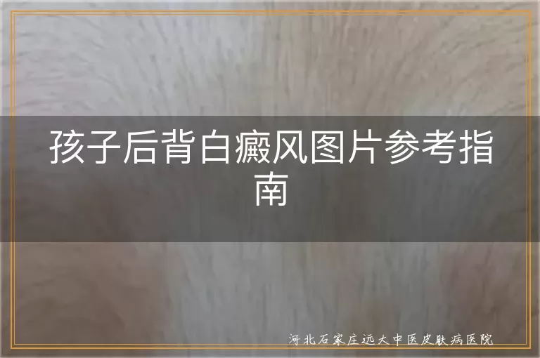 孩子后背白癜风症状,儿童白癜风治疗方法,预防儿童白斑扩散