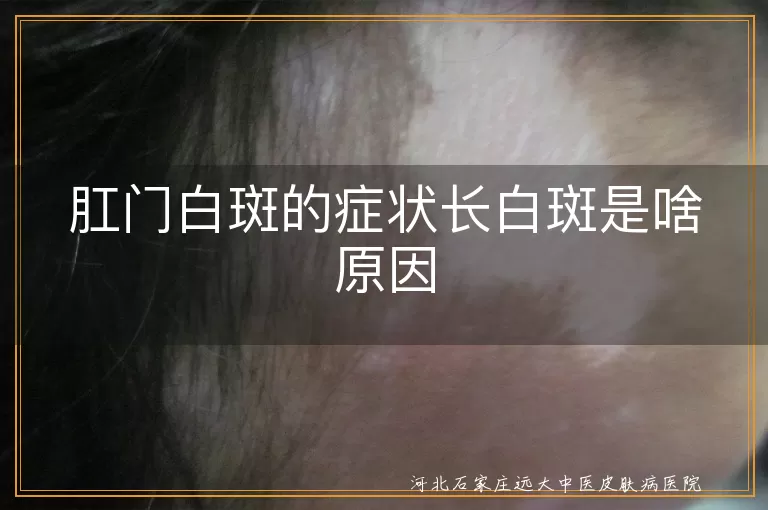肛门白癜风症状,炎症刺激导致白斑,真菌感染引起白斑