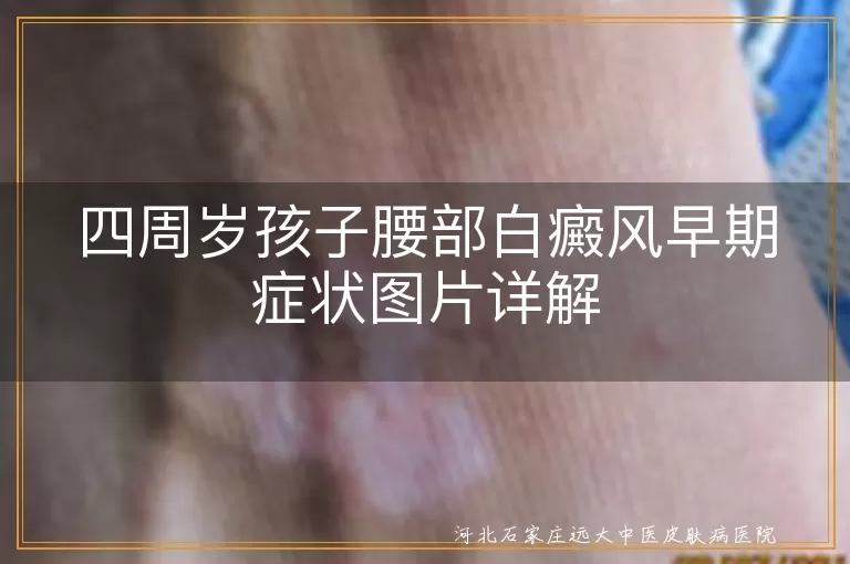 4周岁孩子腰部白癜风症状,儿童腰部白斑早期表现,幼儿腰部白癜风初期图片