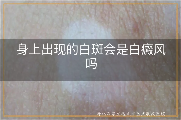 身上白斑是白癜风吗,白斑与白癜风区别,白癜风症状特点