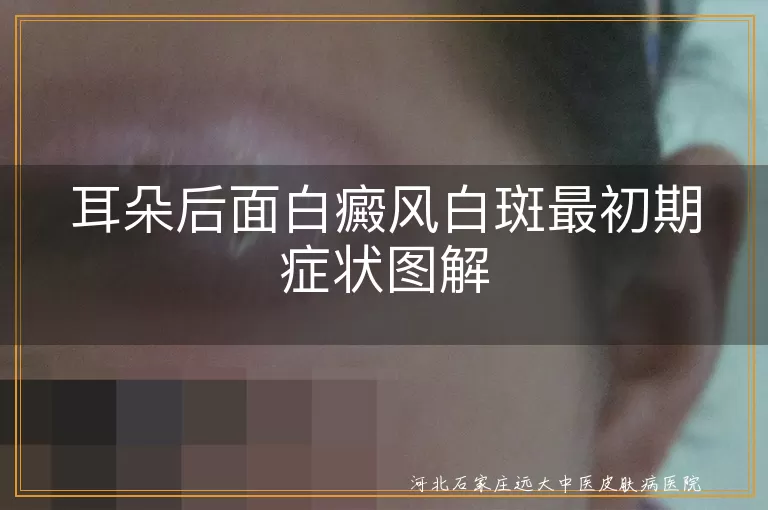 耳朵后面白癜风初期表现,白斑初期症状描述,白癜风最初症状图解