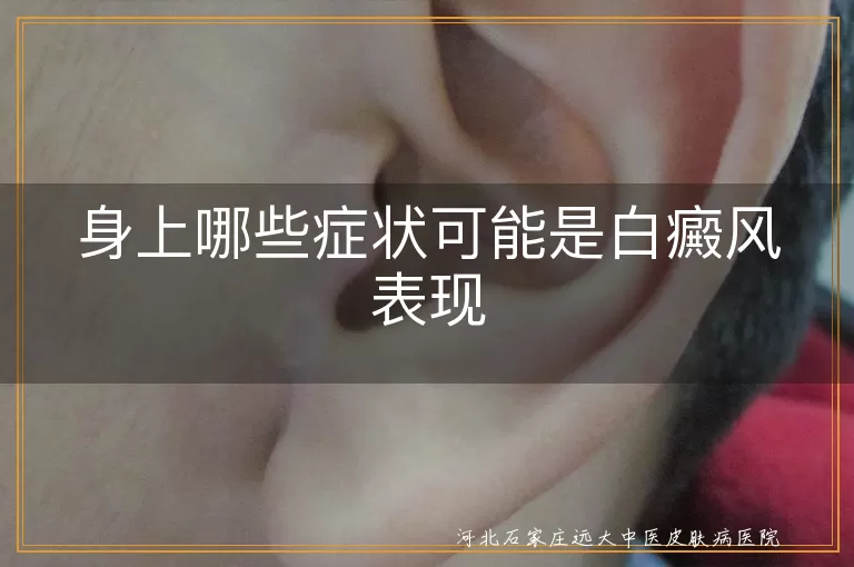 白癜风症状表现,白斑扩散特点,白癜风伴随症状