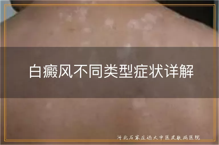 寻常型白癜风症状,节段型白癜风表现,泛发型白癜风特点