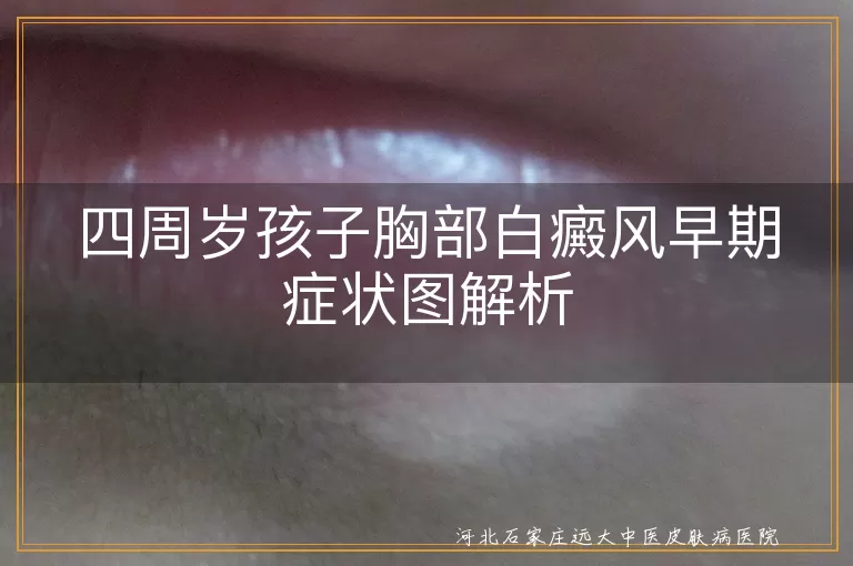 四周岁孩子胸部白癜风早期症状图解析