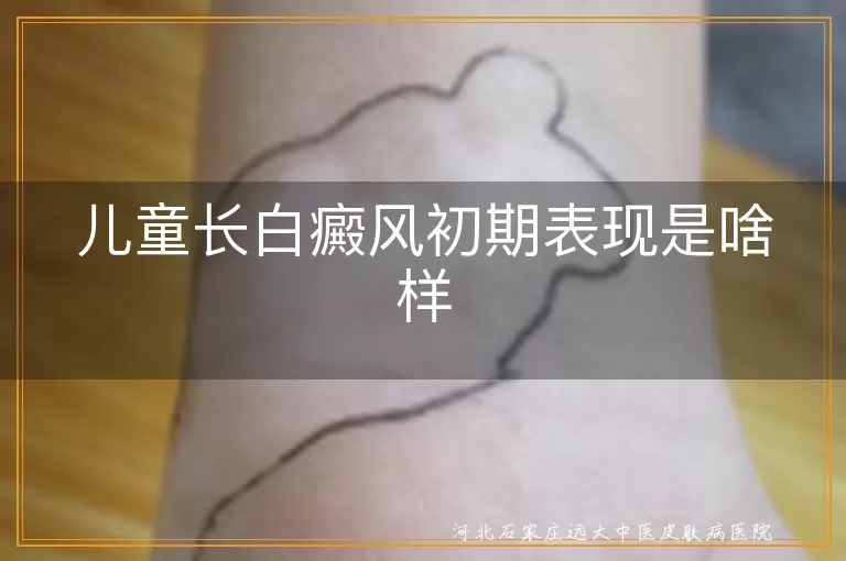 儿童白癜风初期症状,白斑扩散特点,白癜风治疗与护理