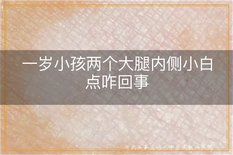 1岁小孩大腿内侧白癜风症状,幼儿白斑可能是无色素痣,儿童皮肤干燥引起白斑