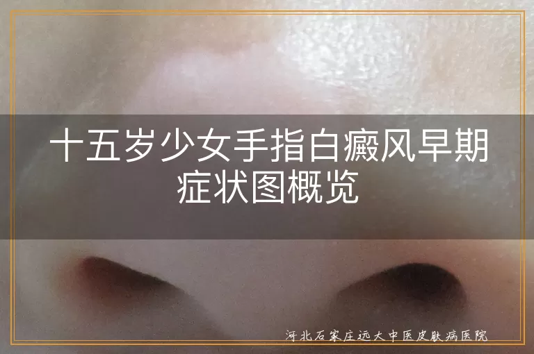 十五岁少女手指白癜风症状,手指白斑早期表现,青少年白癜风早期图例