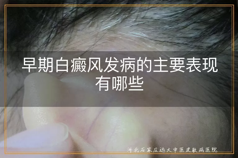 白癜风早期皮肤白斑,白斑边缘清晰症状,白癜风患者毛发变白