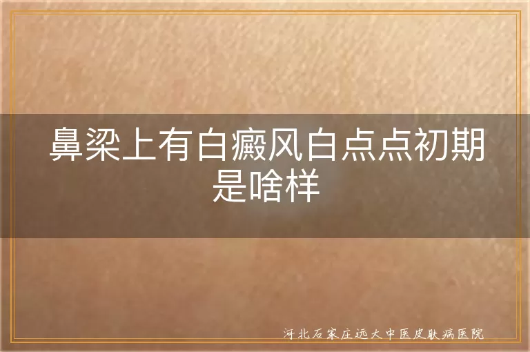 鼻梁白癜风初期症状,白斑初期表现,白癜风预防方法