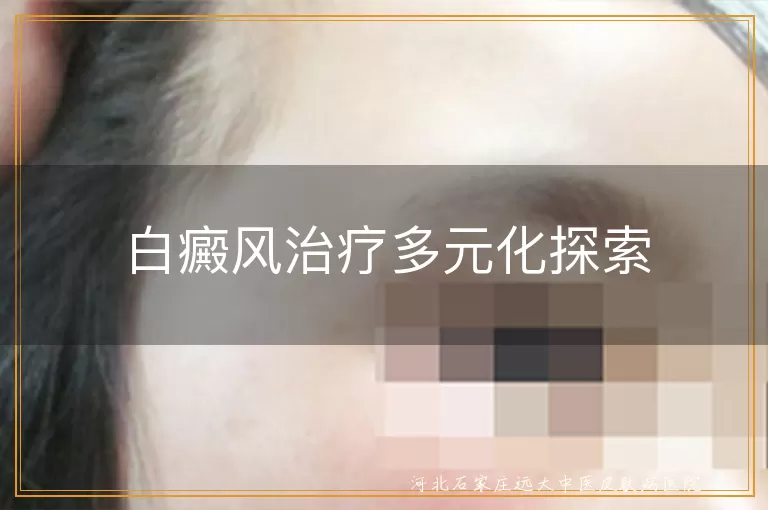 白癜风治疗多元化探索