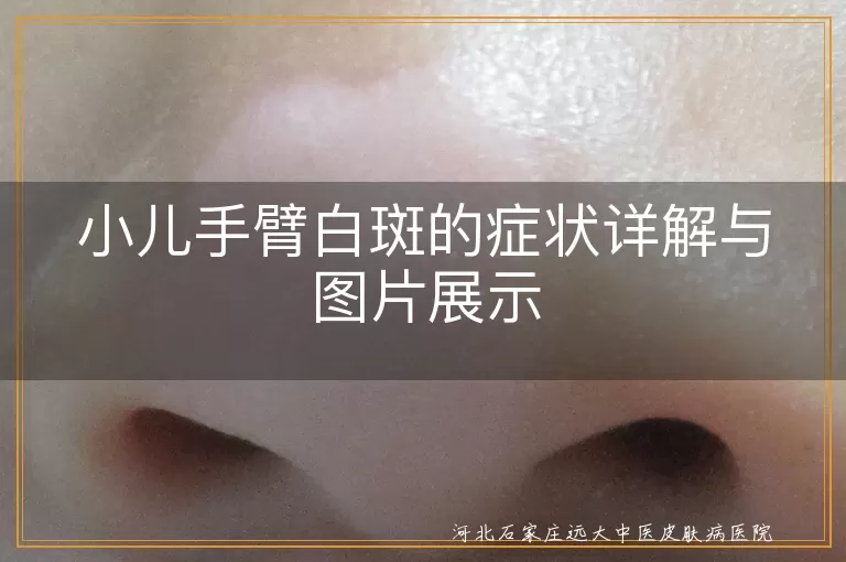 小儿手臂白斑的症状详解与图片展示
