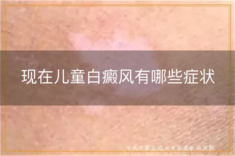 现在儿童白癜风有哪些症状