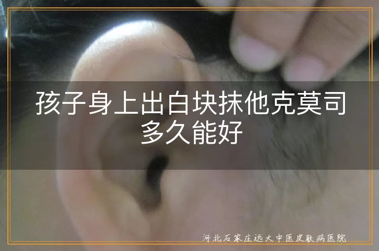 孩子白癜风抹他克莫司多久好,白斑治疗他克莫司效果,白癜风儿童用药时长
