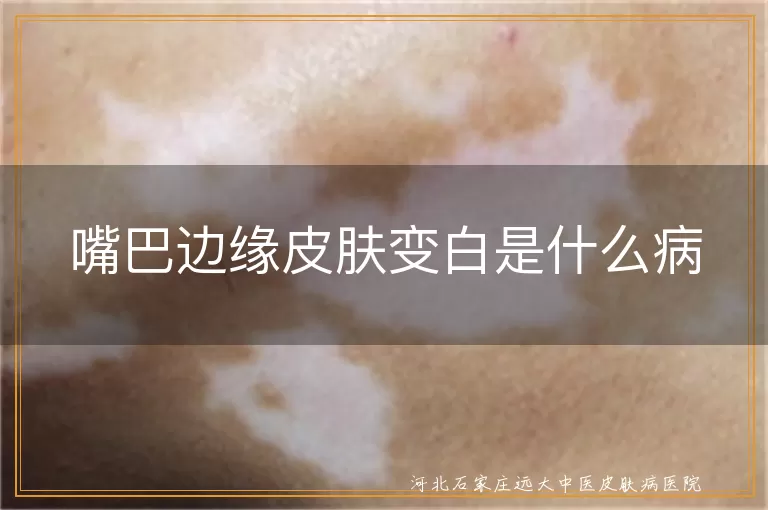 嘴巴边缘皮肤变白与白癜风关系, 白斑出现在嘴巴边缘是什么病, 嘴唇边缘发白可能是白癜风吗