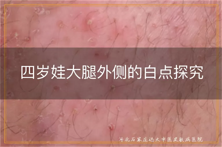 四岁孩子大腿外侧白癜风症状,儿童白斑可能原因,幼儿皮肤白点诊断建议