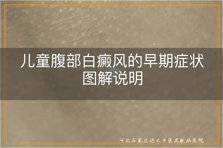 儿童腹部白癜风早期表现,
白斑颜色与形状特点,
儿童白癜风识别图片
