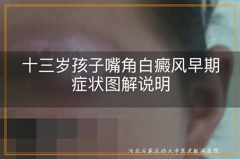13岁孩子嘴角白癜风早期表现,儿童嘴角白斑初期症状,青少年白癜风初期图片识别