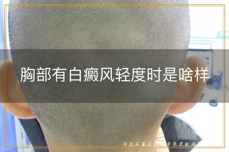 胸部白癜风早期表现,轻度白斑症状描述,白癜风初期图片展示