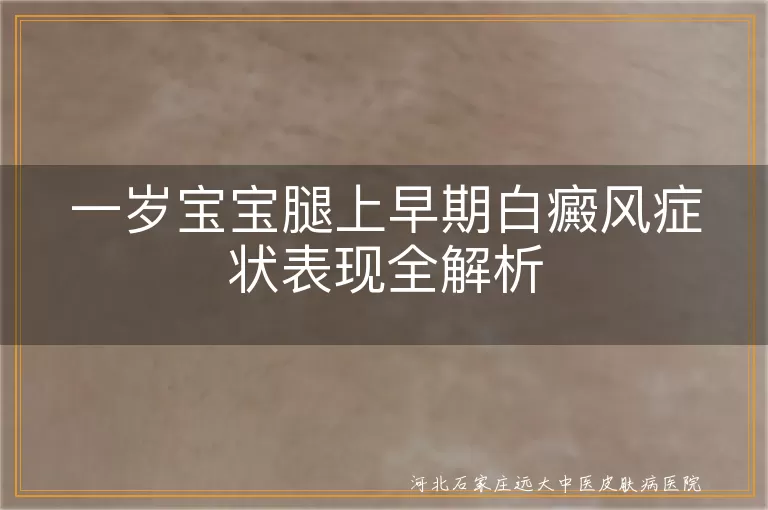 一岁宝宝腿上白癜风症状,早期白斑表现识别,婴幼儿腿部白斑疾病特征