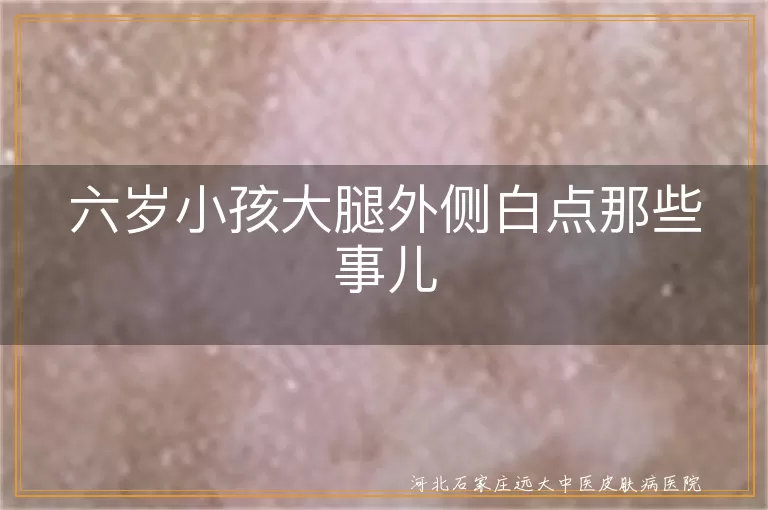 儿童白癜风初识,色素减退斑与白癜风区别,儿童白斑护理经验