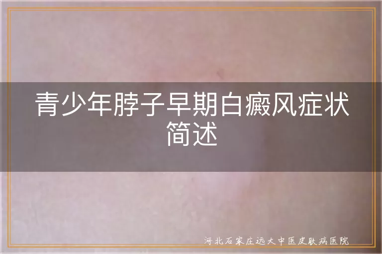 青少年脖子白癜风早期症状,白斑颜色变化特点,白癜风心理影响及预防