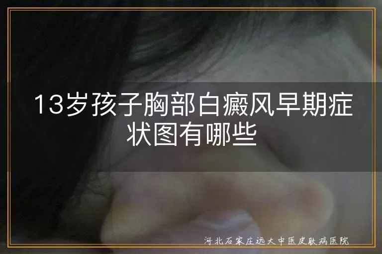 13岁青少年胸部白斑早期识别,青春期孩子白癜风初期症状图片,儿童胸部白癜风早期表现特征
