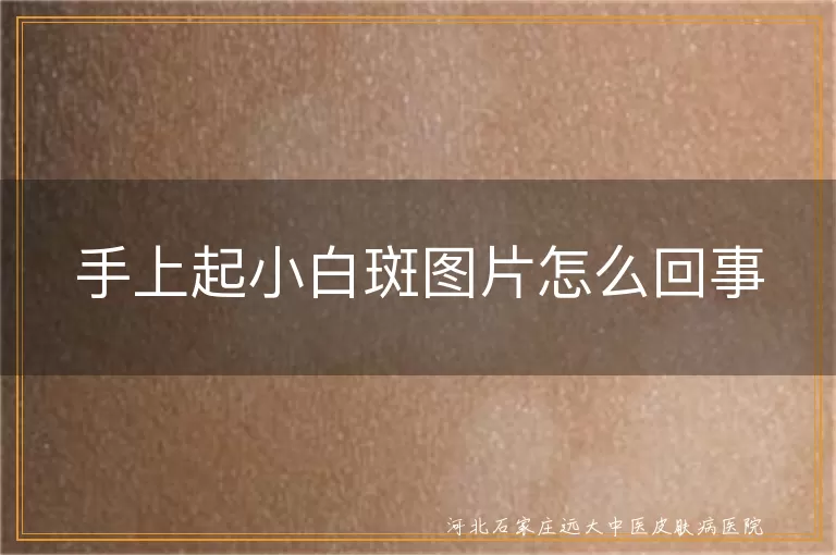 手上白斑初期症状图解,白癜风手部发病图片分析,手部白斑鉴别诊断方法