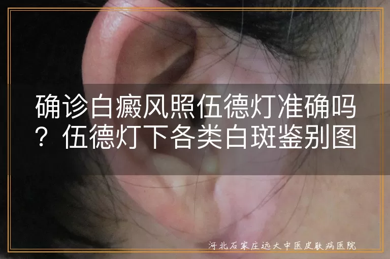 白癜风伍德灯诊断准确性分析,伍德灯下白斑类型鉴别图谱,皮肤白斑伍德灯检测效果评估