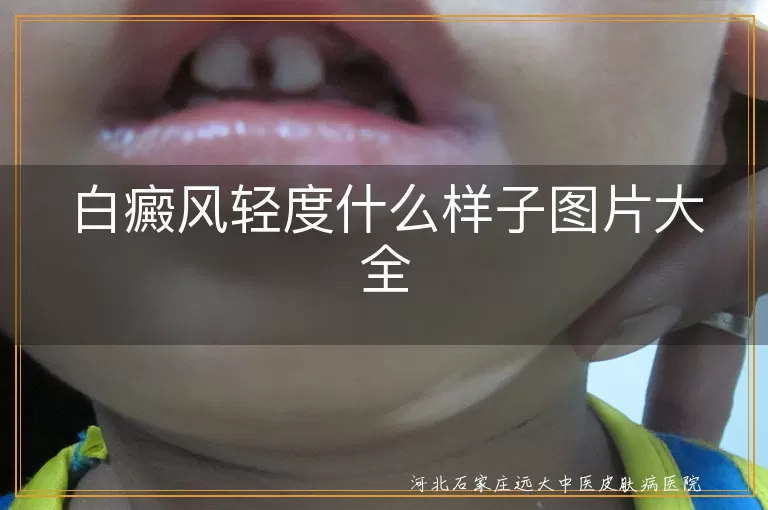 白癜风轻度症状图解,白斑初期形态特征,轻度白癜风临床图片