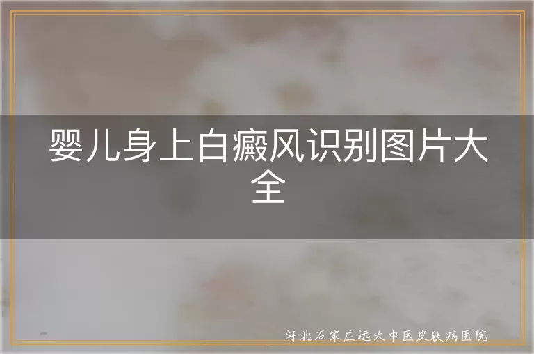 婴儿白癜风早期症状图解,儿童白斑与白癜风鉴别指南,婴幼儿白斑病类型识别图片