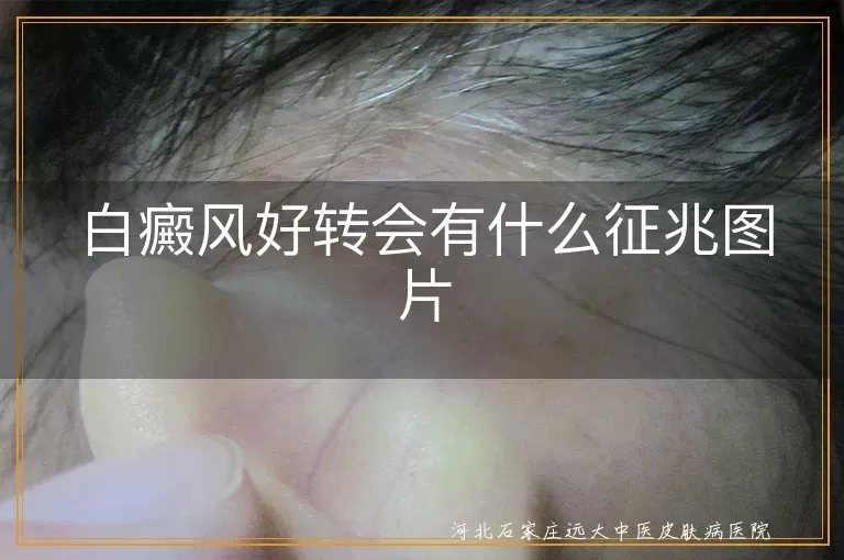 白癜风好转会有什么征兆图片